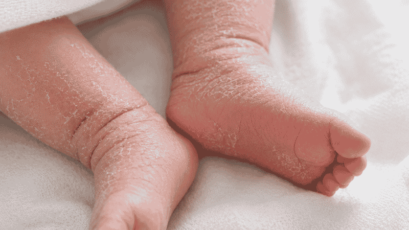 Newborn baby feet and ankles showing typical dry skin peeling in the first two weeks after birth